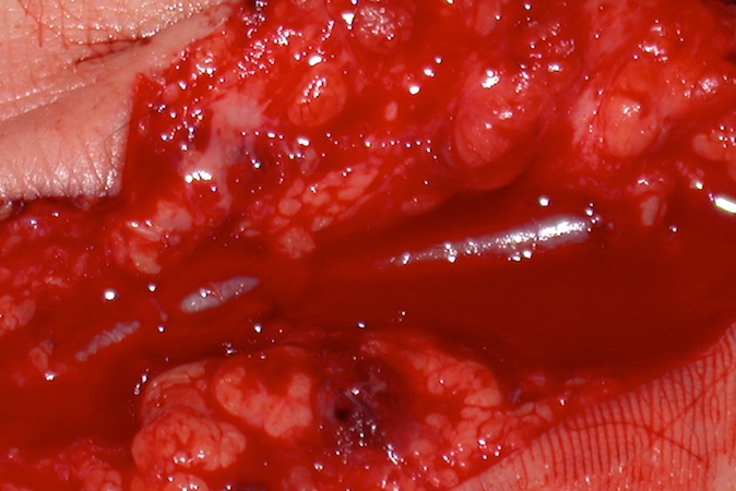 Ulnar artery laceration with brisk antegrade bleeding when tourniquet deflated.