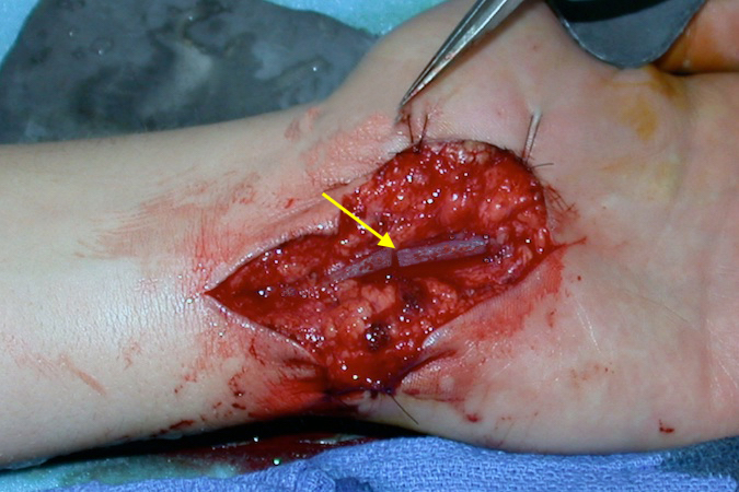 Ulnar artery laceration (arrow) secondary to a cut on a broken window.