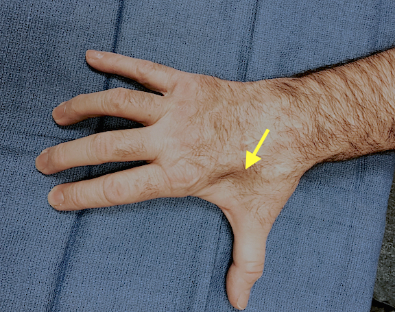 Marked ulnar intrinsic atrophy (arrow) secondary to ulnar nerve laceration.