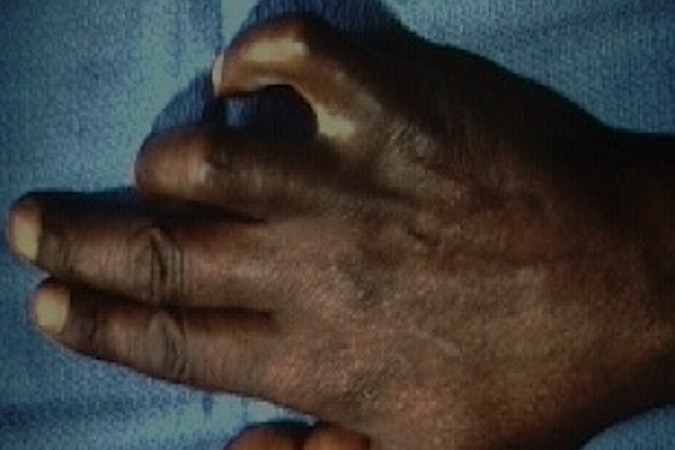 Claw deformity from a chronic untreated ulnar nerve laceration.