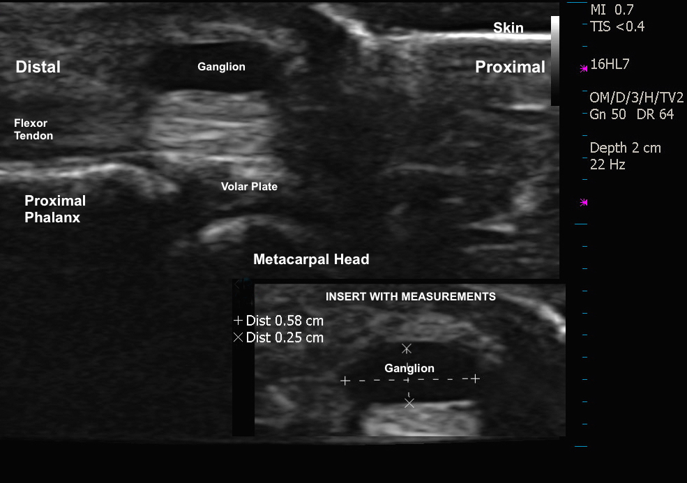 Normal Ultrasound of distal palm except for small ganglion