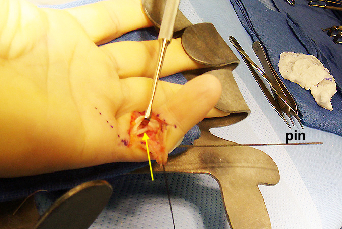 Volar plate rupture left little finger repair which has been augmented with a FDS slip (arrow).  The radial slip was passed under the flexors and sutured to the edge of the A-2 pulley or it can be secured with a bone anchor.