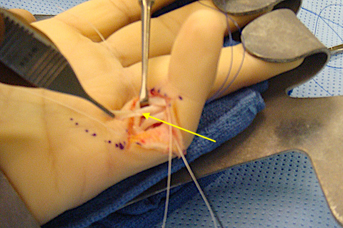 Volar plate rupture left little finger repair which is being augmented with a FDS slip (arrow).