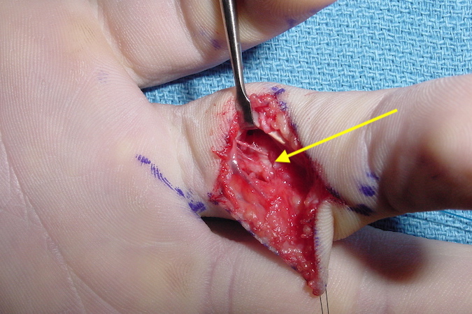 Volar plate rupture right ring finger after suturing with pull out and extra interval suture to accessory collateral or edge of the flexor pulley