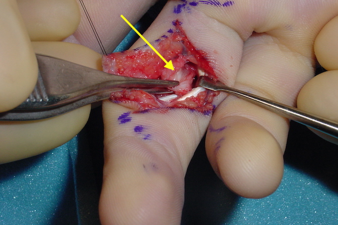  Volar plate rupture right ring finger isolated and ready for repair (arrow)