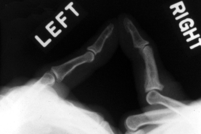 PIP joint stress X-ray demonstrating complete right volar plate rupture.
