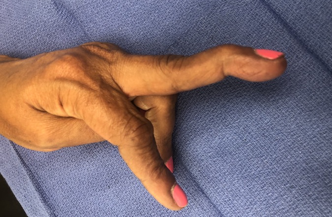 Swan neck deformity secondary to chronic volar plate rupture left long finger PIP joint