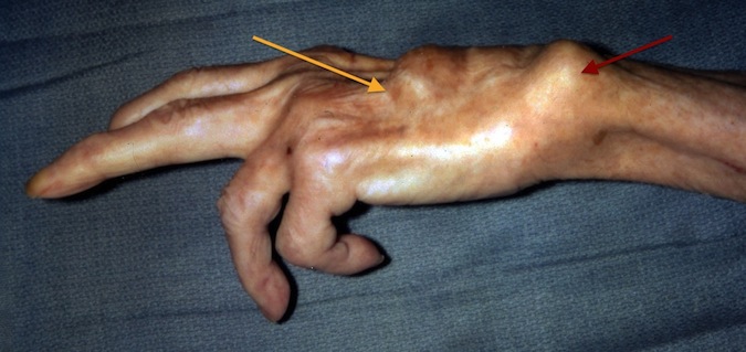 Caput Ulnae Syndrome (Vaughan-Jackson Syndrome); Red arrow - Dorsal dislocated distal ulna; Orange Arrow - Distal ends of ruptured extensor tendons and rheumatoid dorsal tenosynovitis.
