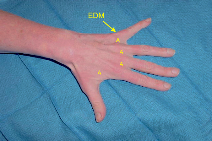 Wartenberg's Sign - Note unopposed pull of the EDM; the ulnar intrinsic atrophy (A); and adduction contracture of the little finger.