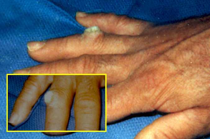 Chronic verruca vulgaris (wart) of right ring finger.