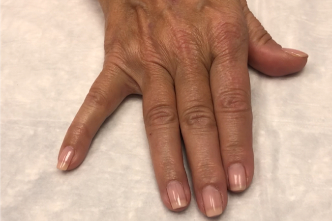 Wartenberg's Sign Right in patient with cubital tunnel syndrome.