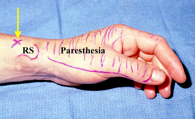 Wartenberg Syndrome with Tinel's sign over the radial sensory nerve (arrow) near the radial styloid (RS) with paresthesias in the are with cross hatch lines.