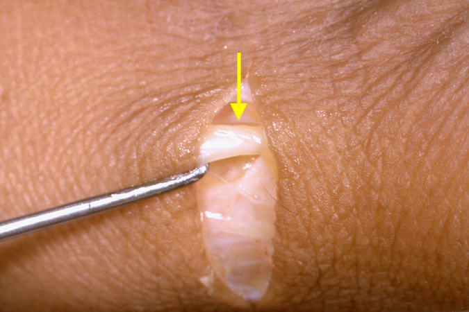 Dorsal radial sensory nerve (arrow) immediately under the skin just distal to the radial styloid