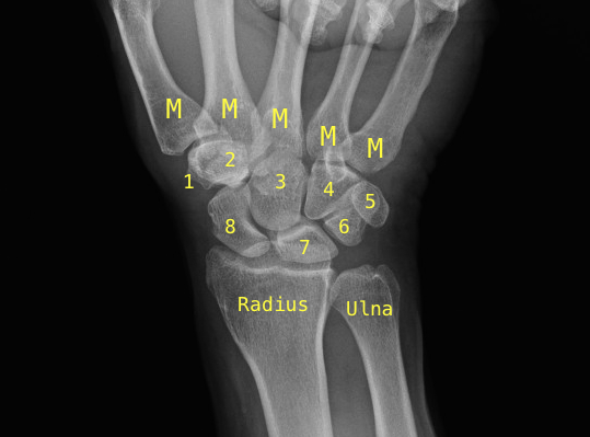 Right Wrist PA View: M- Metacarpal; 1-Trapezium; 2-Trapezoid; 3- Capitate; 4- Hamate; 5- Pisiform; 6- Triquetrum; 7- Lunate; 8- Scaphoid