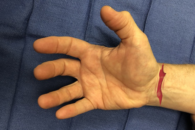 Palmar laceration through volar wrist. Structures at Risk: 1. Skin; 2.Tendons - all FDP & FDS, FCR,FCU,PL; 3. Nerves - Ulnar & Median; 4. Ulnar & Radial Arteries; 5. Bone - Carpal Bones; 6. Carpal Joints.  (Click on structure to see exam)