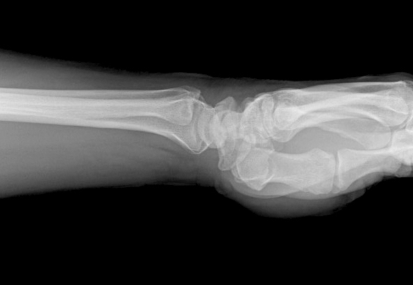 Normal X-ray of distal forearm and wrist (Typical of Intersection Syndrome)