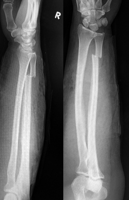 Dog Bite X-Ray - Fracture and air in soft tissues
