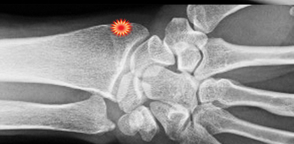 The patient with DeQuervain's tenosynovitis will have tenderness (red dot) but the wrist X-ray will be normal.