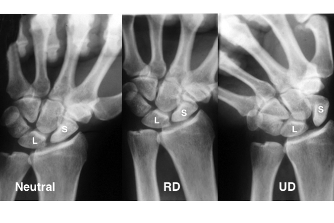 Minimal scaphoid (S)-lunate(L) gap on neutral AP X-ray, no gap on radial(R) deviated(D) view and larger gap on ulnar (U) deviated(D) view. 