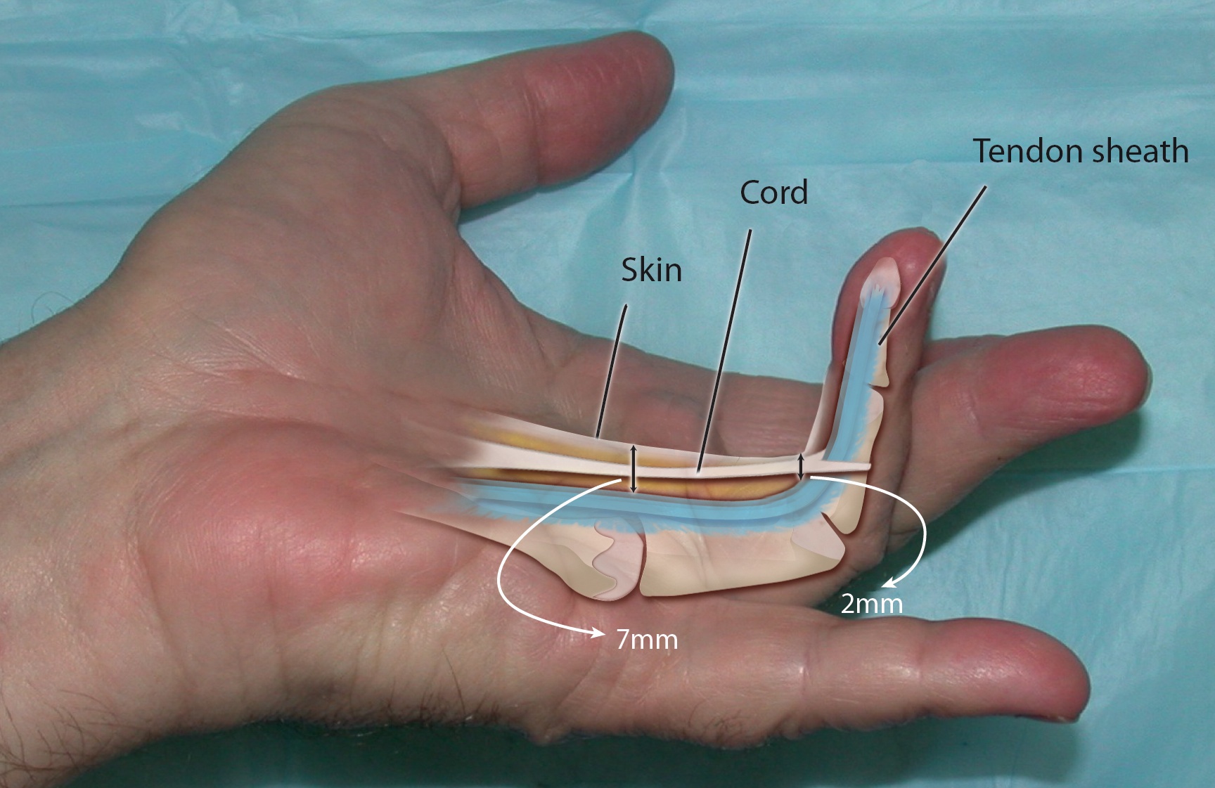 A Dupuyten's central cord displaced palmarly and "bowstrung" away from the flexor tendon sheath. Average distance from skin to sheath in the palm is 7mm and at the PIP level this distance is 4mm.