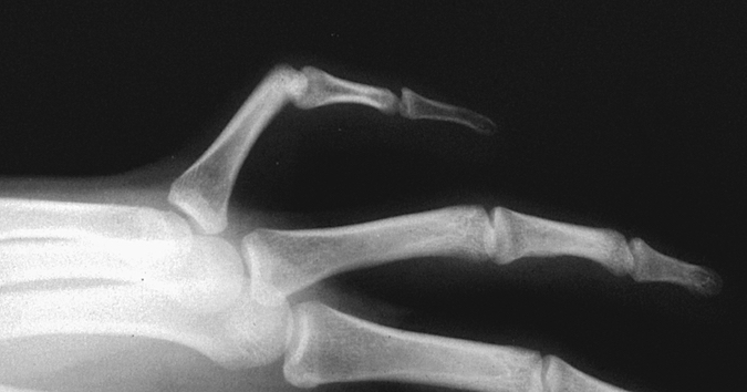 Fifth finger camptodactyly oblique X-ray