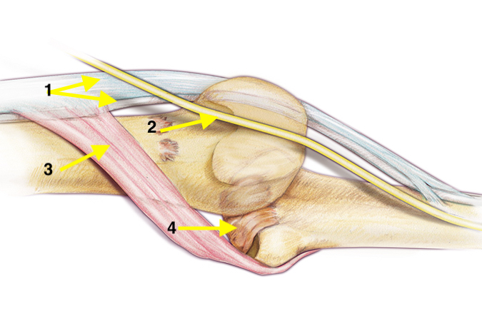 A. Extensor tendon; B. Central slip; C. Oblique fibers of the dorsal aponeurosis; D. Lateral slip; E. Conjoined lateral band; F. Triangular ligament; G. Terminal extensor tendon 