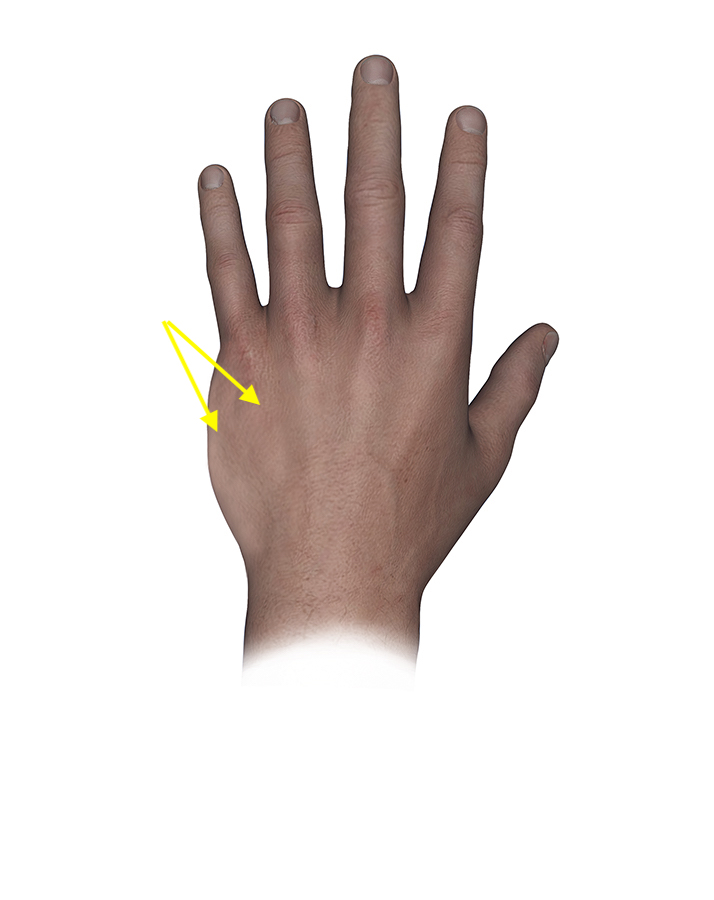  Osteosarcoma of the left fifth metacarpal with dorsal and ulnar swelling (arrows)
