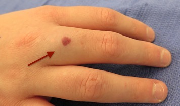 Hemangioma - note swelling at base of long finger compared to index and ring fingers