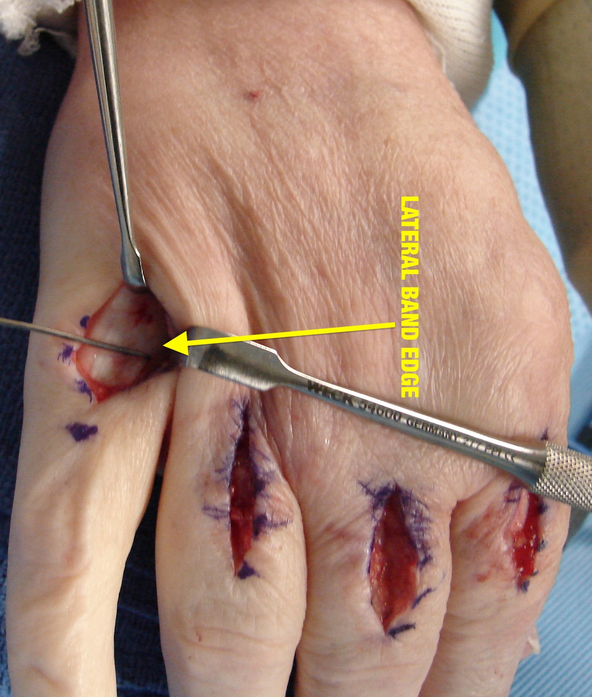 Littler Intrinsic Releases - Triangle of lateral band is removed radially and ulnarly.