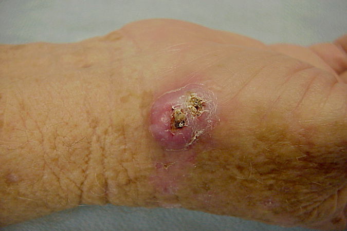 Keratoacanthoma at the base of the right thumb in a 58 y.o. male home builder.  He noted the enlarging lesion 9 weeks ago.