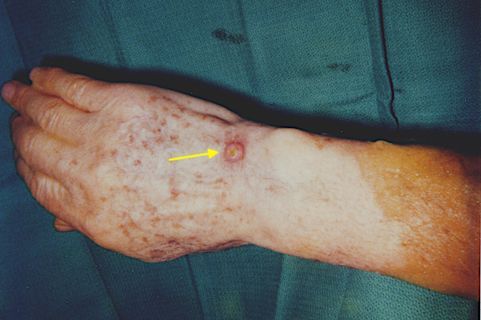 Keratoacanthoma in 75 y.o. male dorsal ulnar base of hand (arrow)