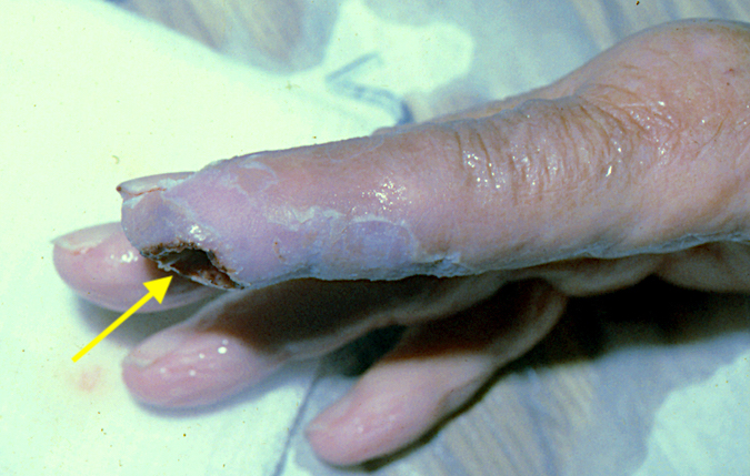 Melanoma right index fingertip (arrow)