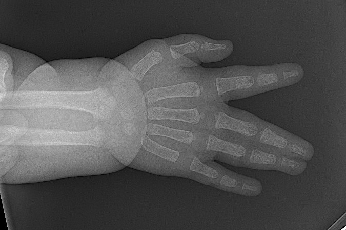 X-ray of left long-ring simple syndactyly