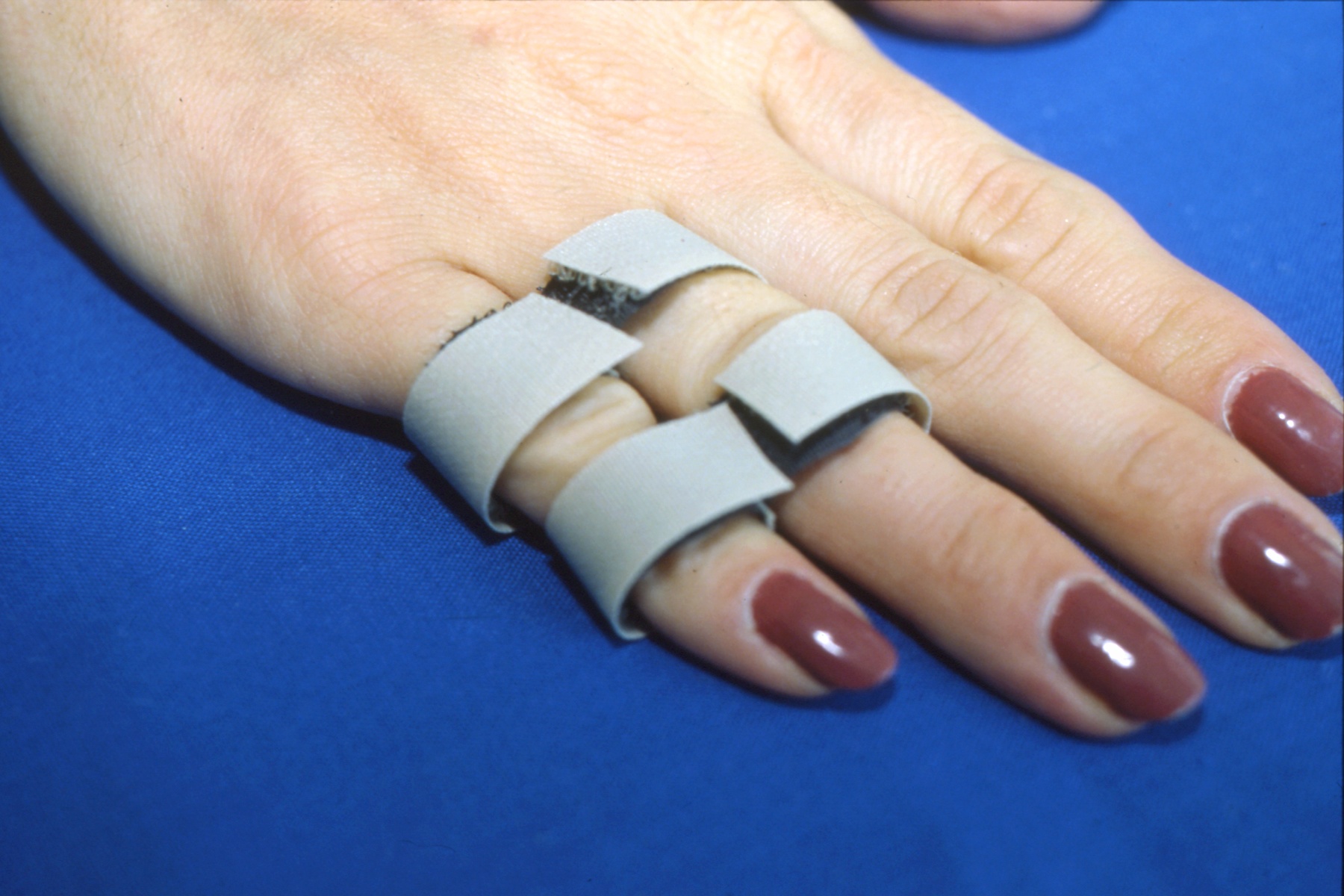 For stable and anatomically reduced PIP dislocations, buddy tape splinting and early active ROM may be the only treatment needed.
