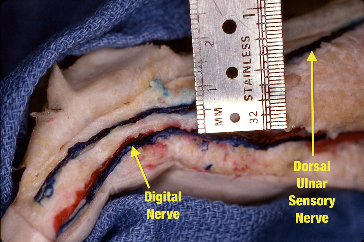 The ulnar digital nerve and dorsal sensory nerve