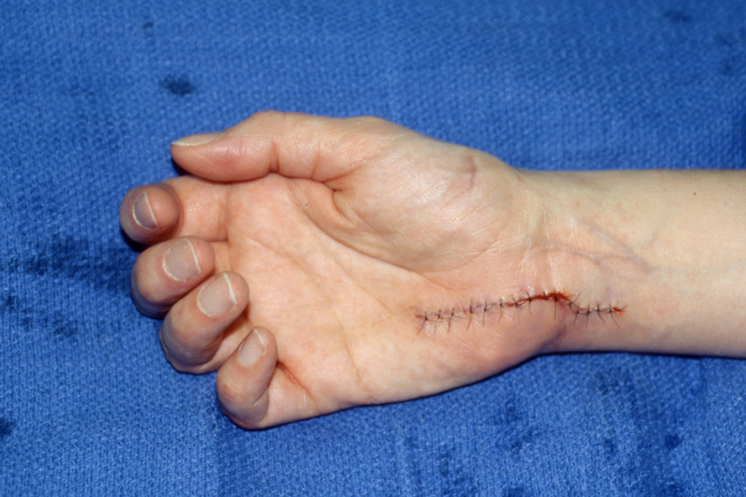 Guyon's canal incision closed after releasing the carpal tunnel, Guyon's canal release, and excising a ganglion compressing the main ulnar nerve and the motor branch of the ulnar nerve.