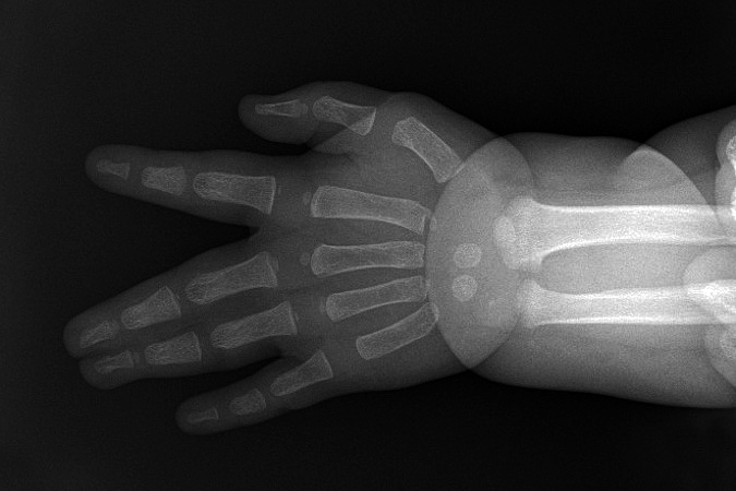 X-ray of right III-IV complete simple syndactyly