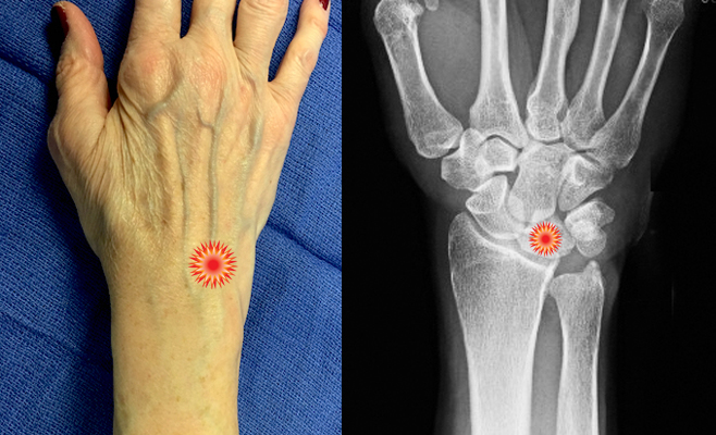 The red "tender" sign pin points the area of tenderness in relationship to the distal ulna, distal radius  and the dorsal wrist surface anatomy of a patient with  a Kienbock's Disease.
