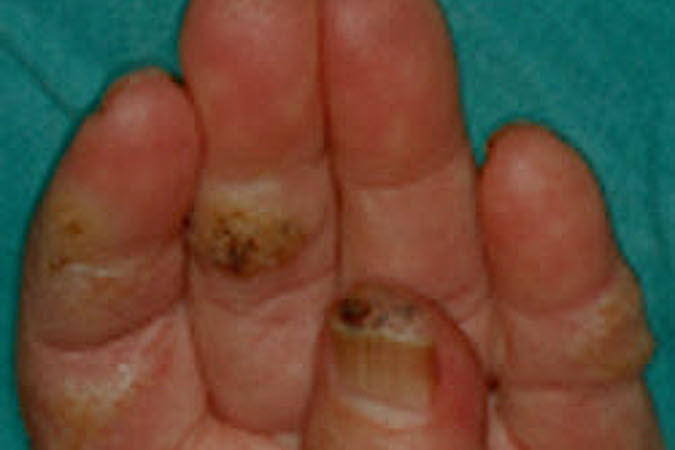 Multiple verruca vulgaris (warts) in left hand of a immunocompromised patient